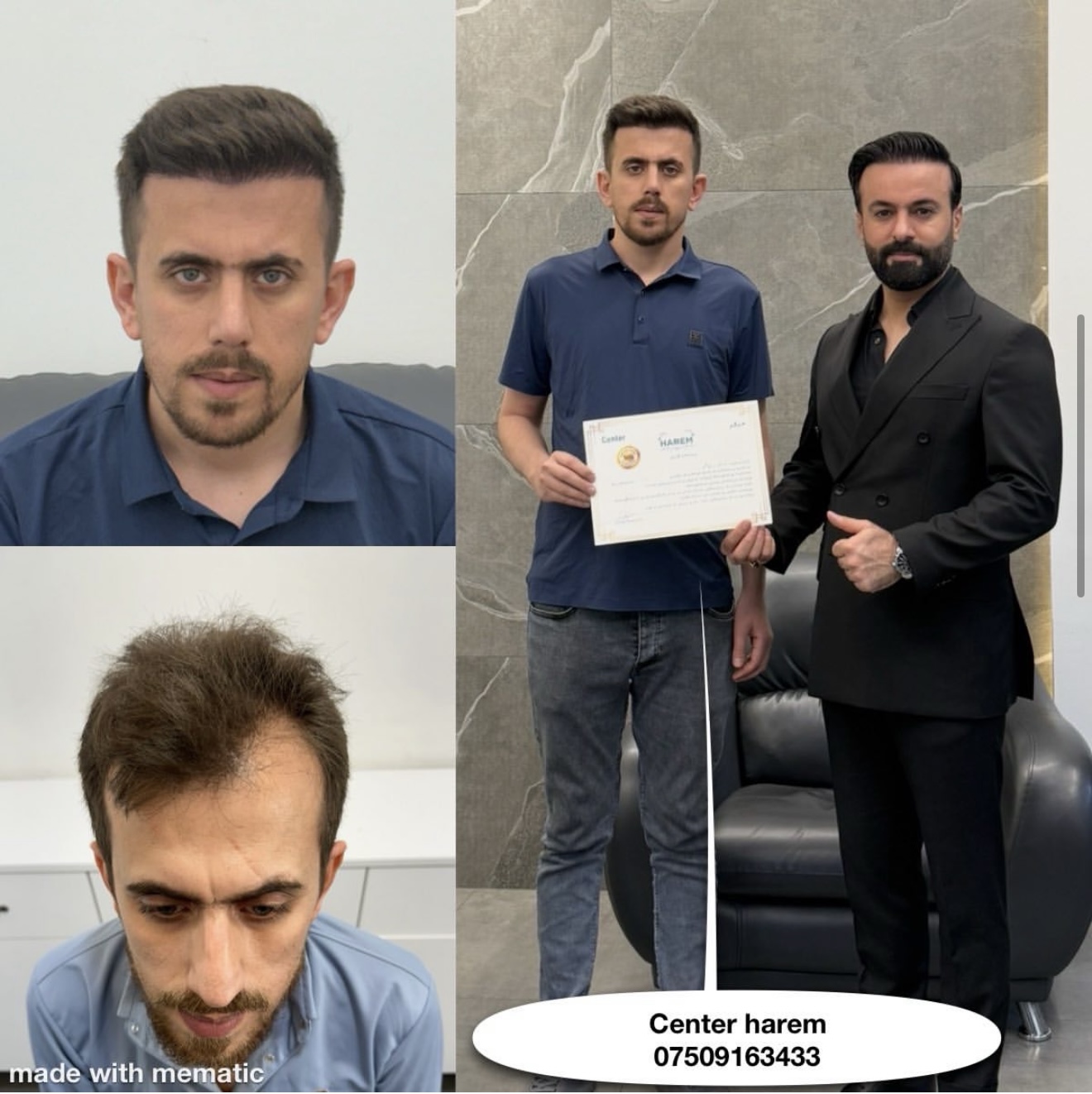 Beard Hair Transplant