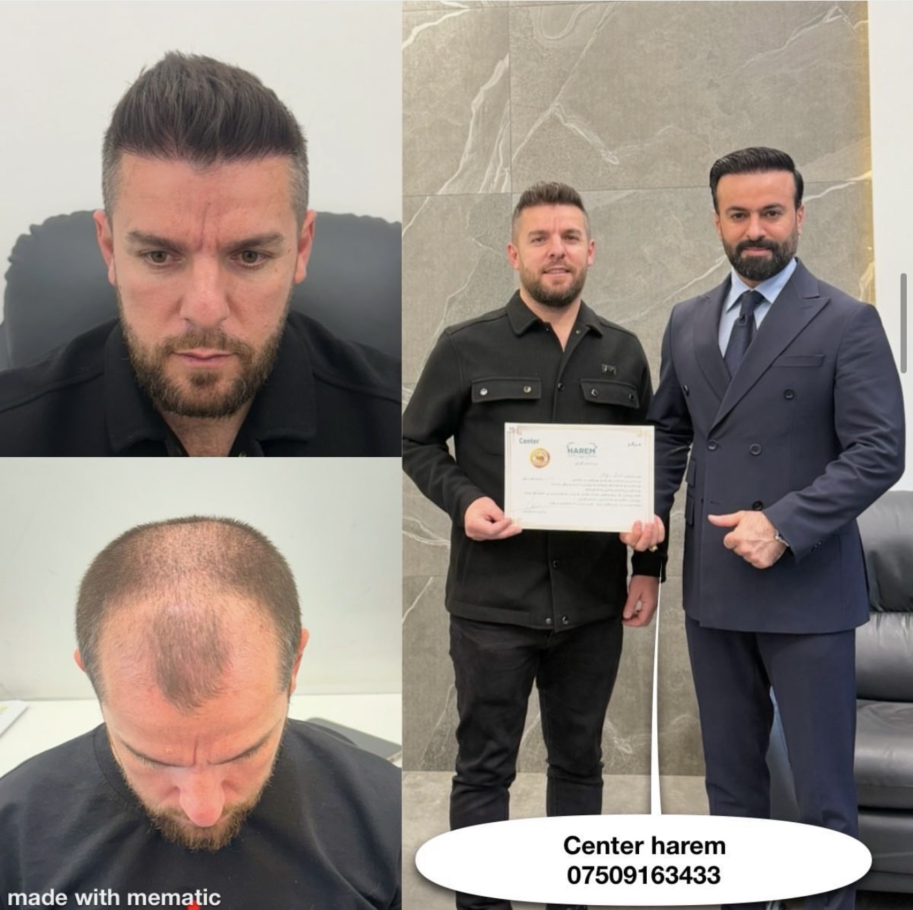 Crown Hair Transplant