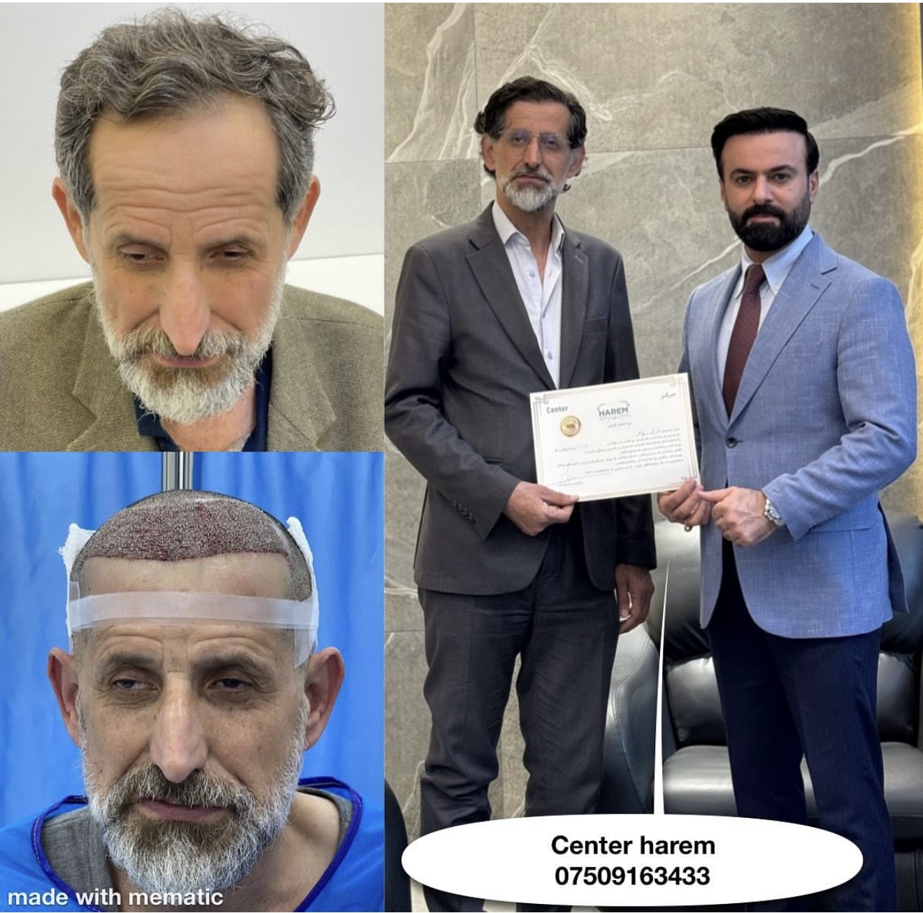 Beard Hair Transplant