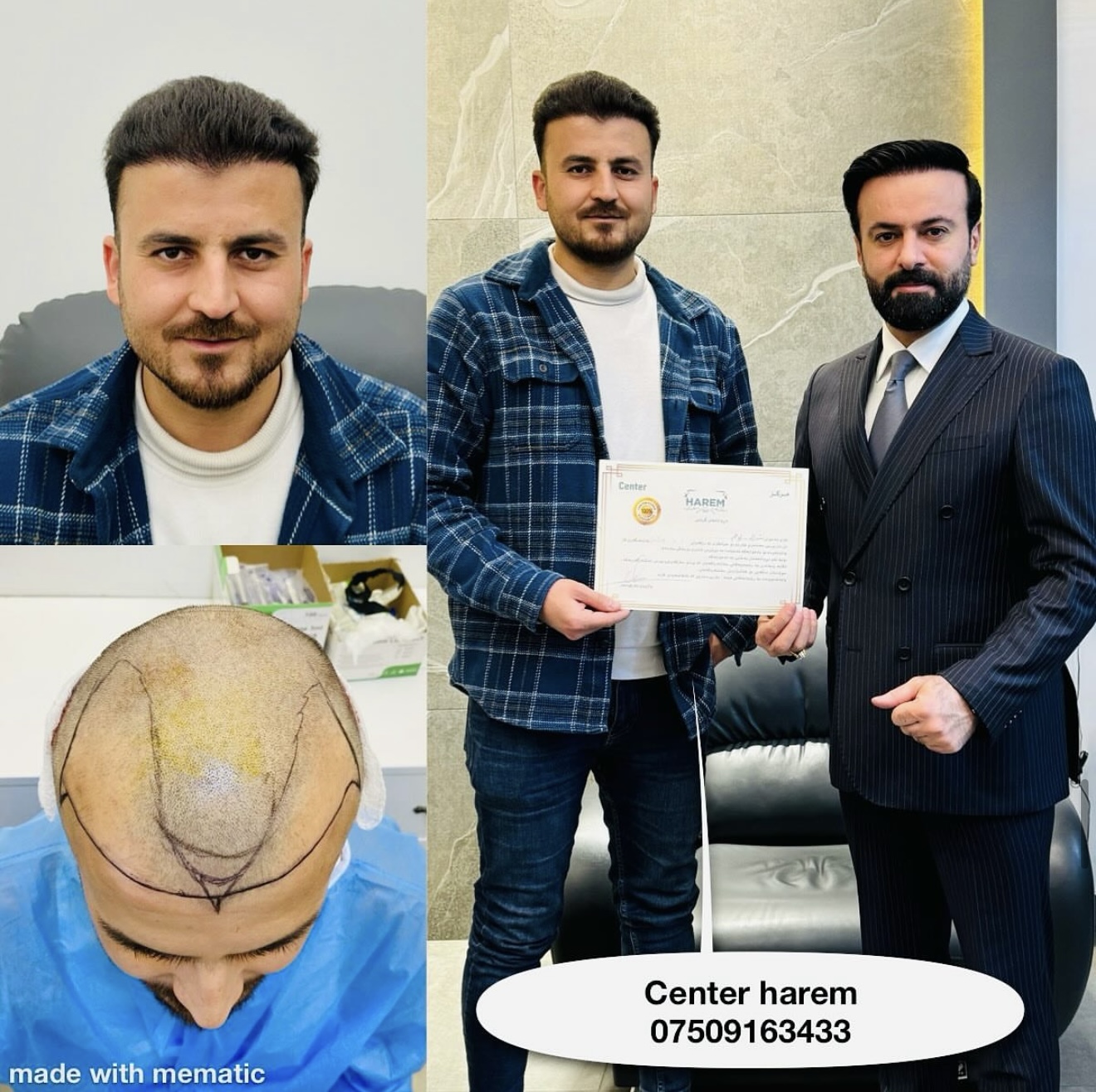 Crown Hair Transplant